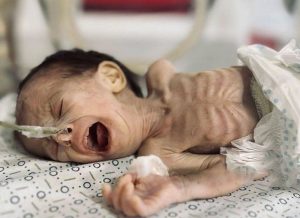 enfant mort à Gaza à cause de la faim